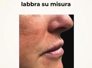 Dott. Giovanni Migliorini Correzione dell’arcata dentaria inferiore con acido ialuronico