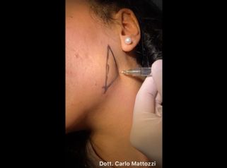 Filler - Dott. Carlo Mattozzi