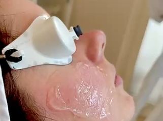 Dott.ssa Cornelia FloreaRingiovanimento del viso con luce pulsata