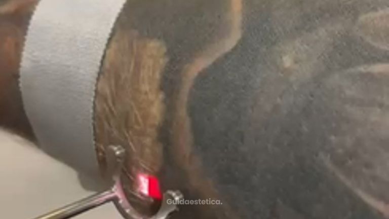 Dott.ssa Cornelia Florea Rimozione tatuaggio nero con laser