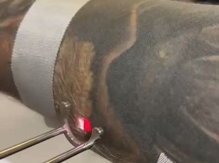 Dott.ssa Cornelia Florea Rimozione tatuaggio nero con laser