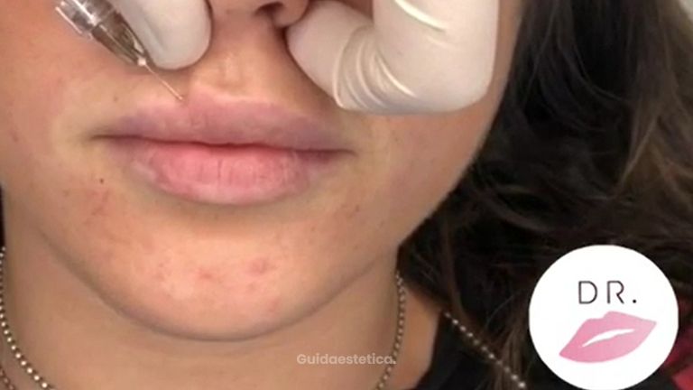 Filler Labbra by Dr. Pierluigi Gigliofiorito for Dr. Lips