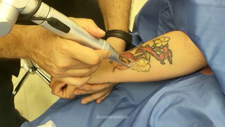 Rimozione tatuaggi - Dott.Maurizio Cursano