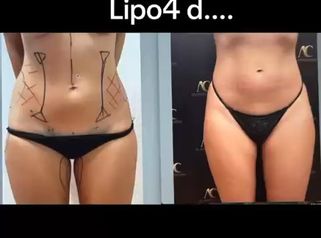 Dottor Alberto Capone Lipo4D addome: definizione e armonia