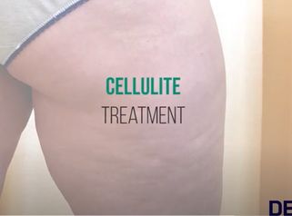 DEKA Tutorial ONDA Trattamento Cellulite