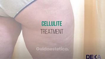 DEKA Tutorial ONDA Trattamento Cellulite