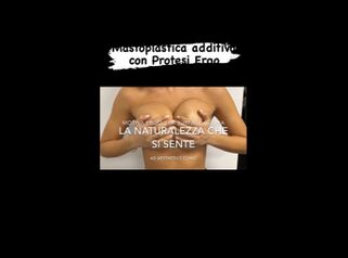 Mastoplastica additiva - Dott. Alessandro Dall’Antonia
