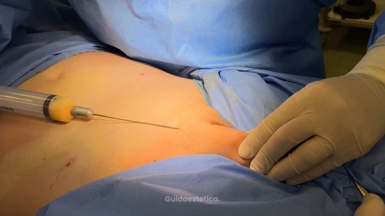 Lipofilling - Dott. Antonio Ruffo