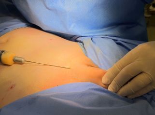 Lipofilling - Dott. Antonio Ruffo