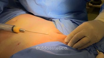 Lipofilling - Dott. Antonio Ruffo