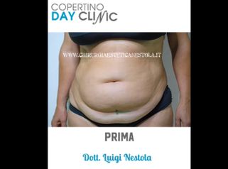 Addominoplastica - Chirurgia Estetica Nestola - Dott. Luigi Nestola