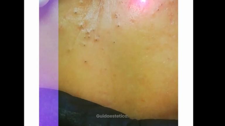 Eliminazione punti neri con laser