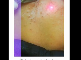 Eliminazione punti neri con laser