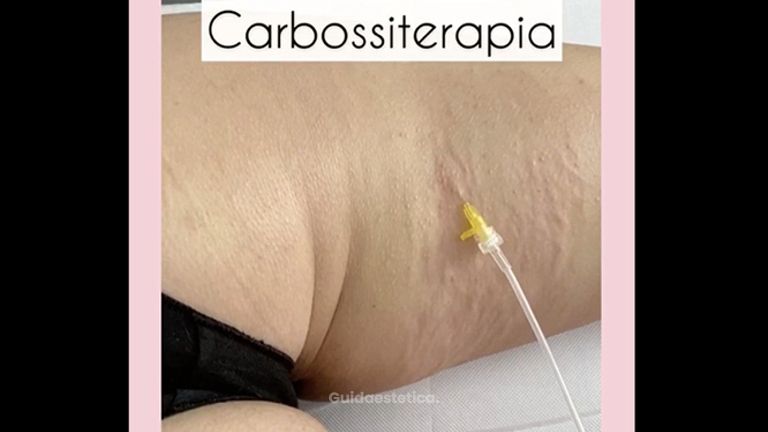 Carbossiterapia