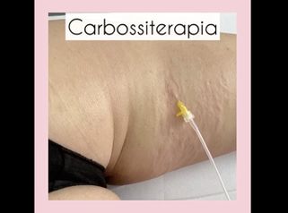 Carbossiterapia