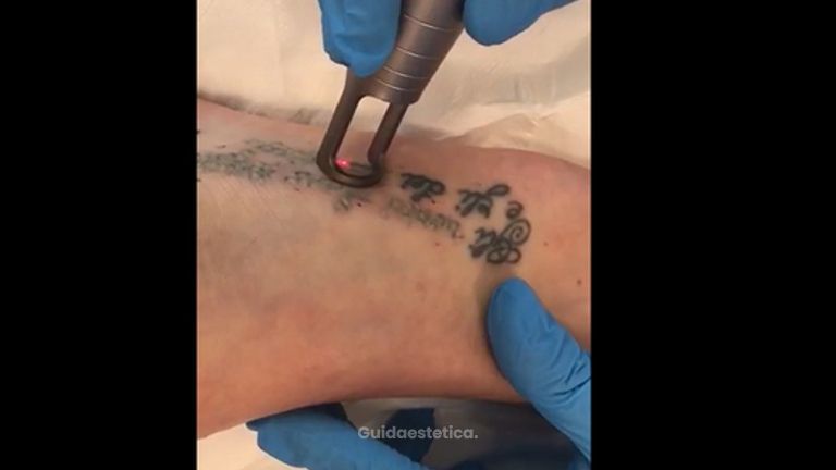 Dott. Vitale: Rimozione tatuaggio