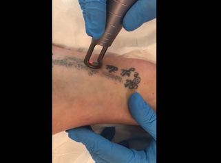 Dott. Vitale: Rimozione tatuaggio