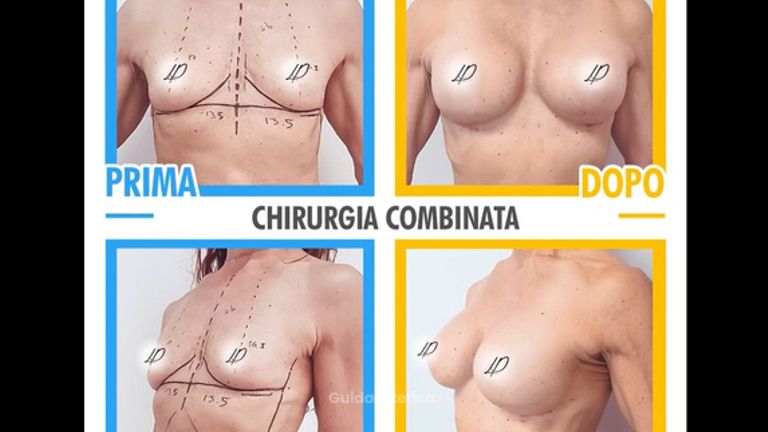 Combined surgery