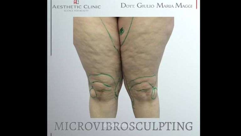 Microvibrosculpting - Aesthetic Clinic del Dott. Giulio Maria Maggi