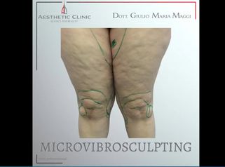 Microvibrosculpting - Aesthetic Clinic del Dott. Giulio Maria Maggi