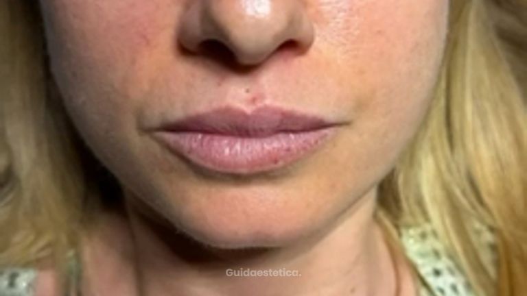 Dott. Michele Benedetto Filler labbra naturale: prima e dopo il trattamento