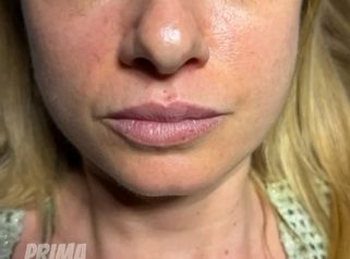 Dott. Michele Benedetto Filler labbra naturale: prima e dopo il trattamento