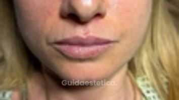 Dott. Michele Benedetto Filler labbra naturale: prima e dopo il trattamento