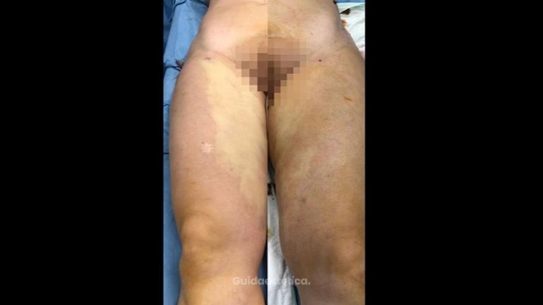 Liposuzione - Dott. Dario Bazzano