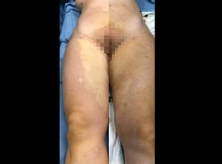 Liposuzione - Dott. Dario Bazzano