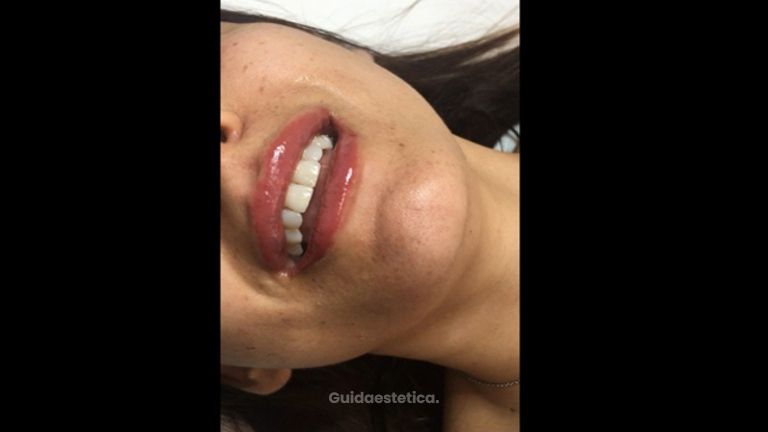 Filler labbra