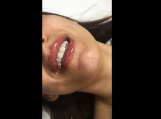 Filler labbra