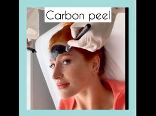 Carbon peel