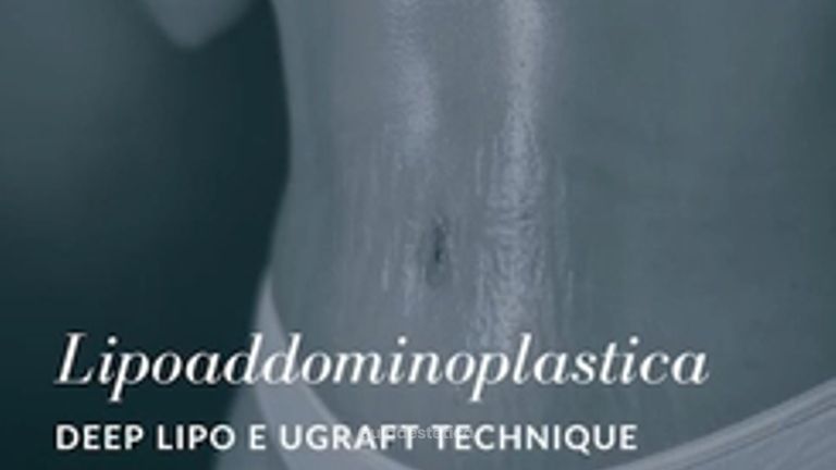 Lipoaddominoplastica - Dott. Arturo Amoroso