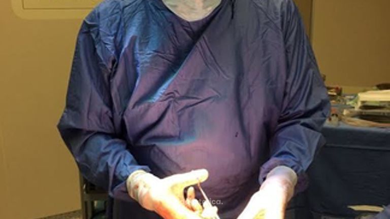 La Gluteoplastica eseguita dal Dott. Capone