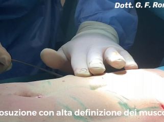 Liposuzione - Dott. Federico Romano