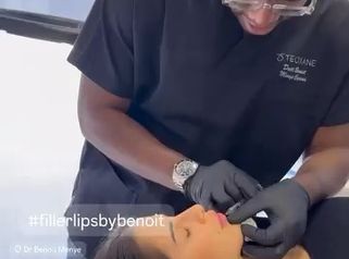 Dott. Benoit Menye Filler labbra: applicazione e risultato dopo il trattamento
