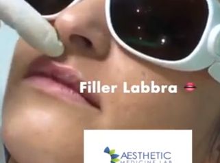 Post Filler Labbra