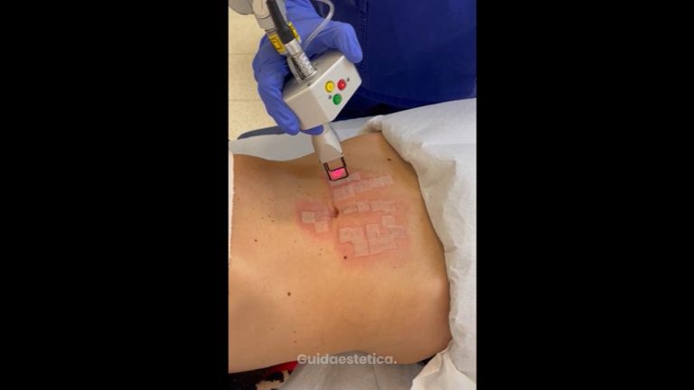 Laser CO2 Frazionato - Dott. Valerio Scarano Catanzaro